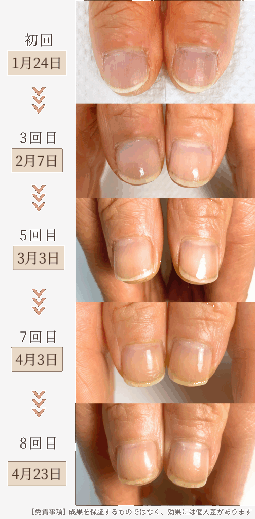 お悩み：薄い爪 乾燥 甘皮の自爪育成ケア 3ヶ月コース育成過程