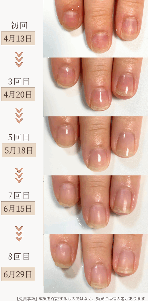 お悩み：薄い 噛み癖 深爪の自爪育成ケア 3ヶ月コース育成過程1