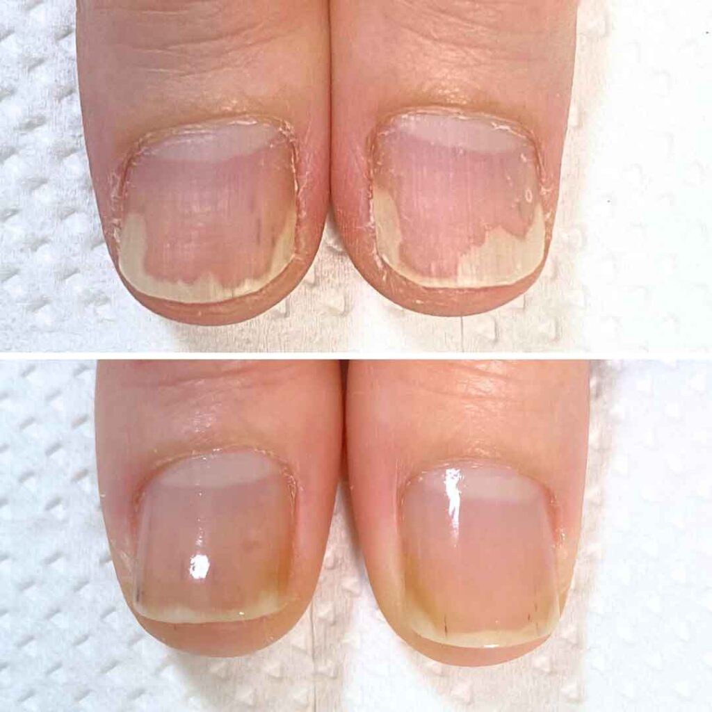 K様 女性/30代/介護職
お悩み：爪甲剥離の症例写真