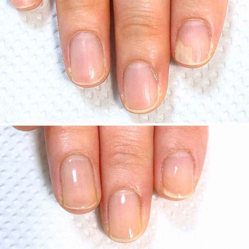 K様 女性/30代/介護職
お悩み：爪甲剥離の症例写真3