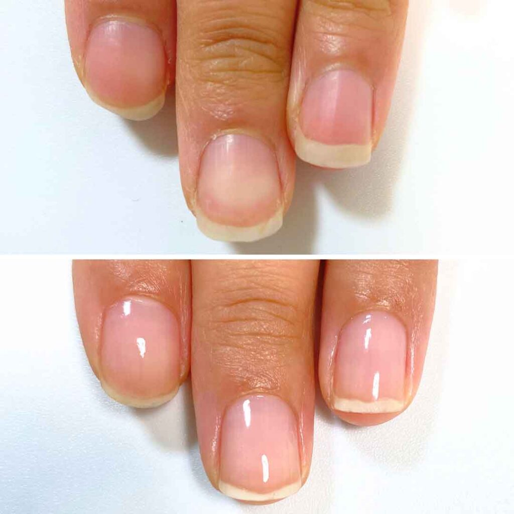 お悩み：欠ける爪 2枚爪の症例写真2