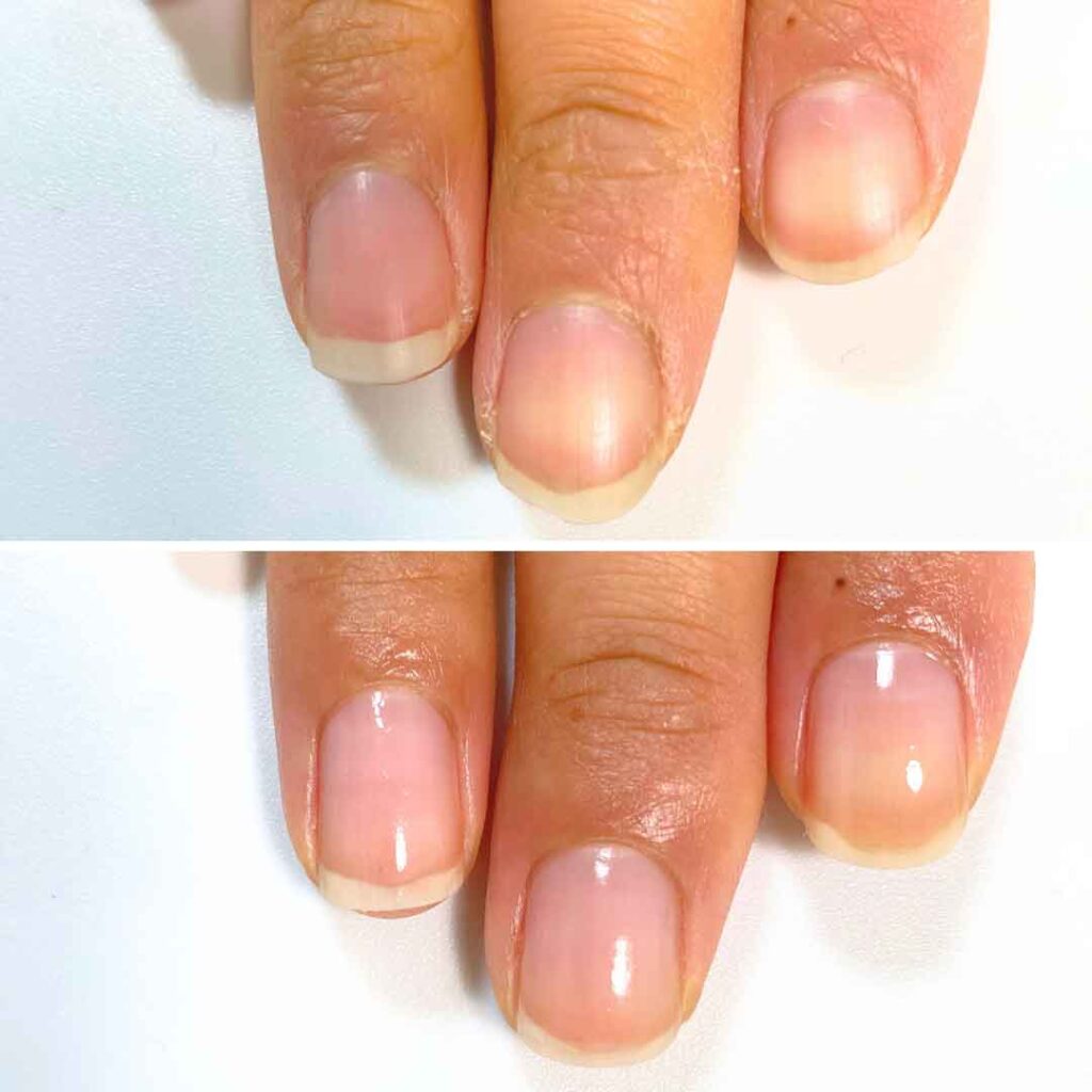 お悩み：欠ける爪 2枚爪の症例写真3