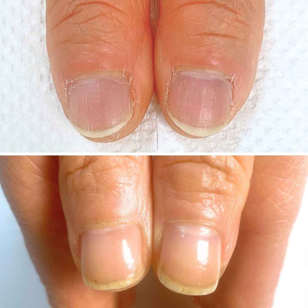 お悩み：薄い 乾燥 甘皮の症例写真1