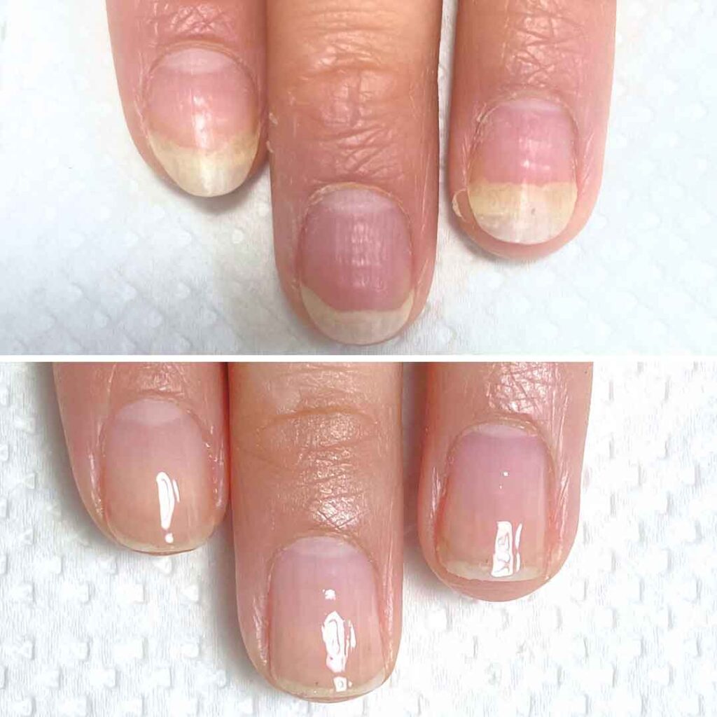 お悩み：爪甲剥離の症例写真2