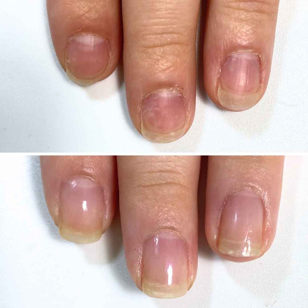 お悩み：薄い爪 乾燥 噛み癖の症例写真2