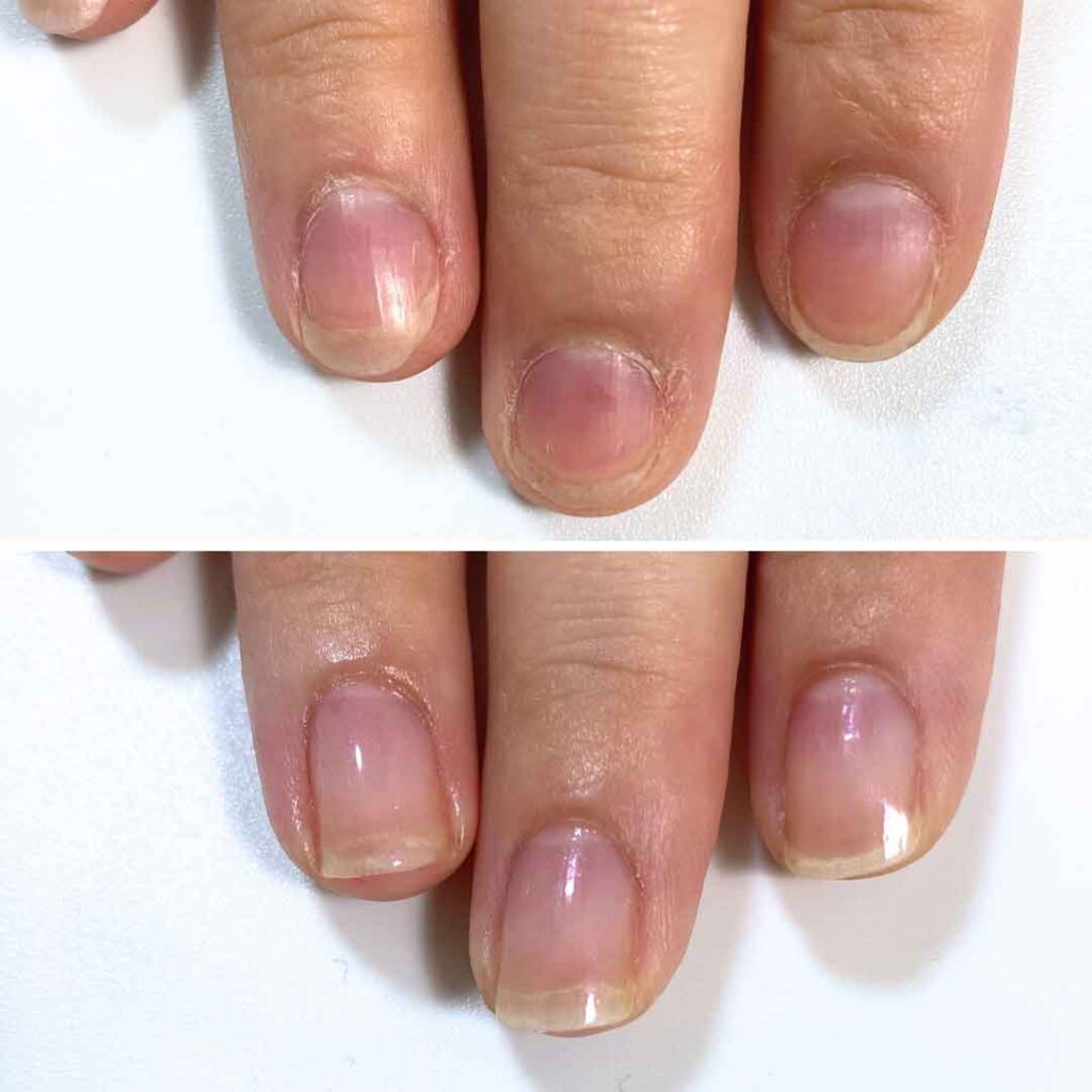お悩み：薄い爪 乾燥 噛み癖の症例写真3