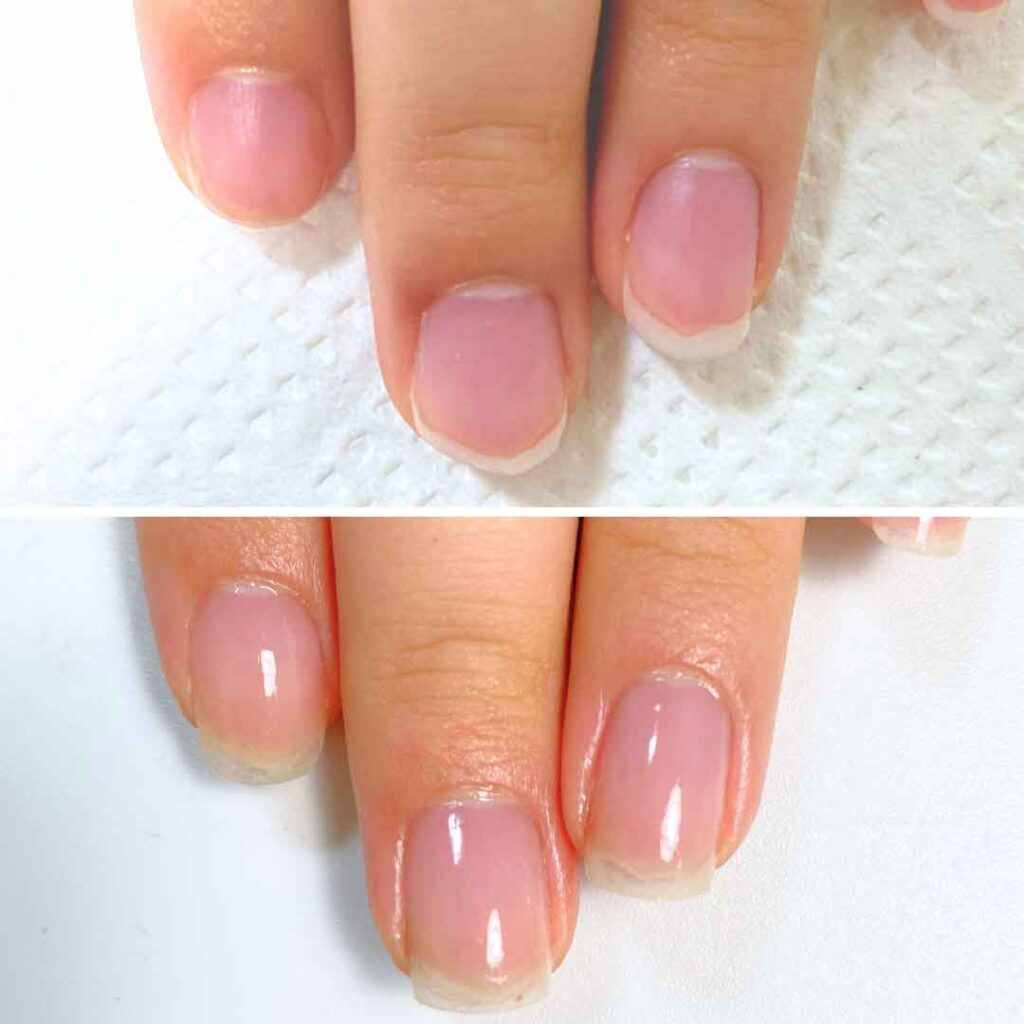 お悩み：小さい爪 乾燥 いじり癖の症例写真2