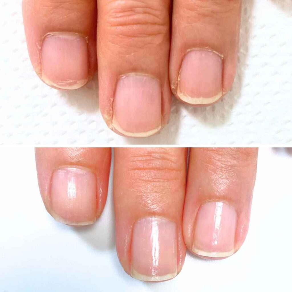 お悩み：縦筋 乾燥の症例写真2