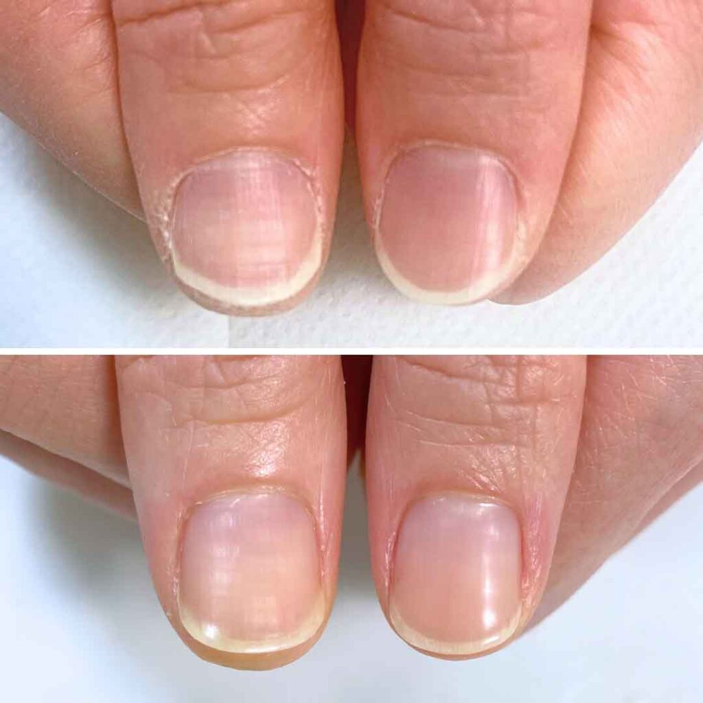 お悩み：乾燥 2枚爪 反り爪の症例写真1