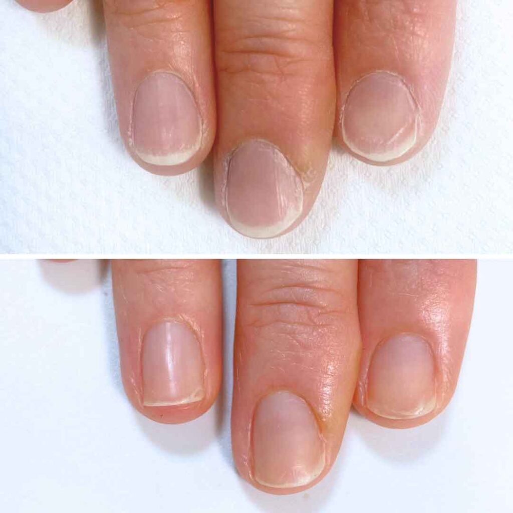 お悩み：乾燥 2枚爪 反り爪の症例写真2