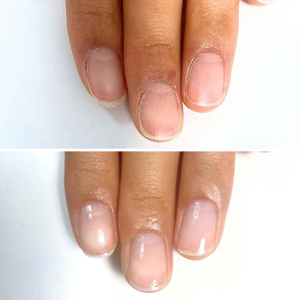 お悩み：薄い爪 縦筋 2枚爪の症例写真2