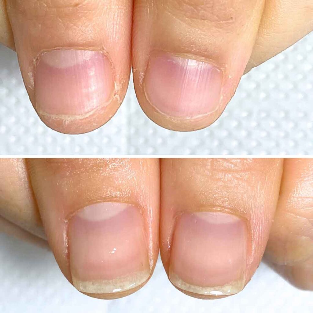 Y様 女性/20代/薬剤師
お悩み：深爪 乾燥
初回→8回目(約3ヶ月)の症例写真