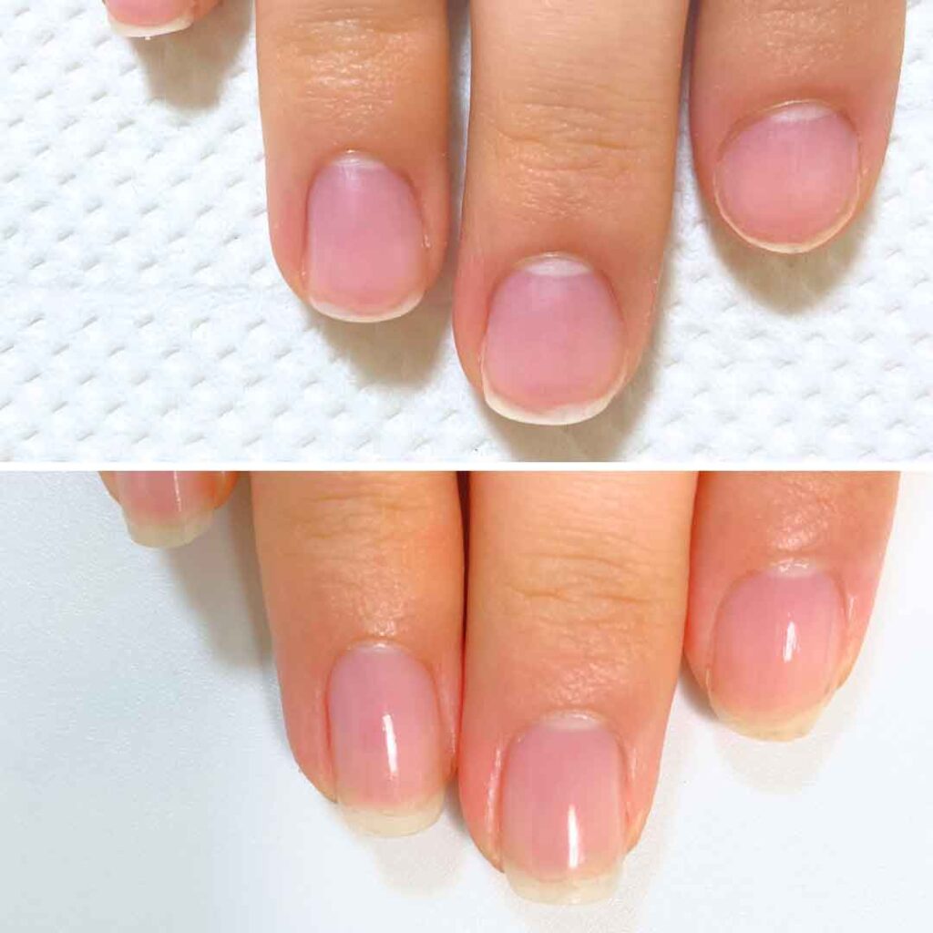 K様 女性/30代/介護職
お悩み：爪甲剥離
初回→8回目(約3ヶ月)症例写真