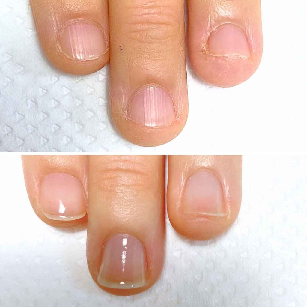 Y様 女性/20代/薬剤師
お悩み：深爪 乾燥
初回→8回目(約3ヶ月)の症例写真