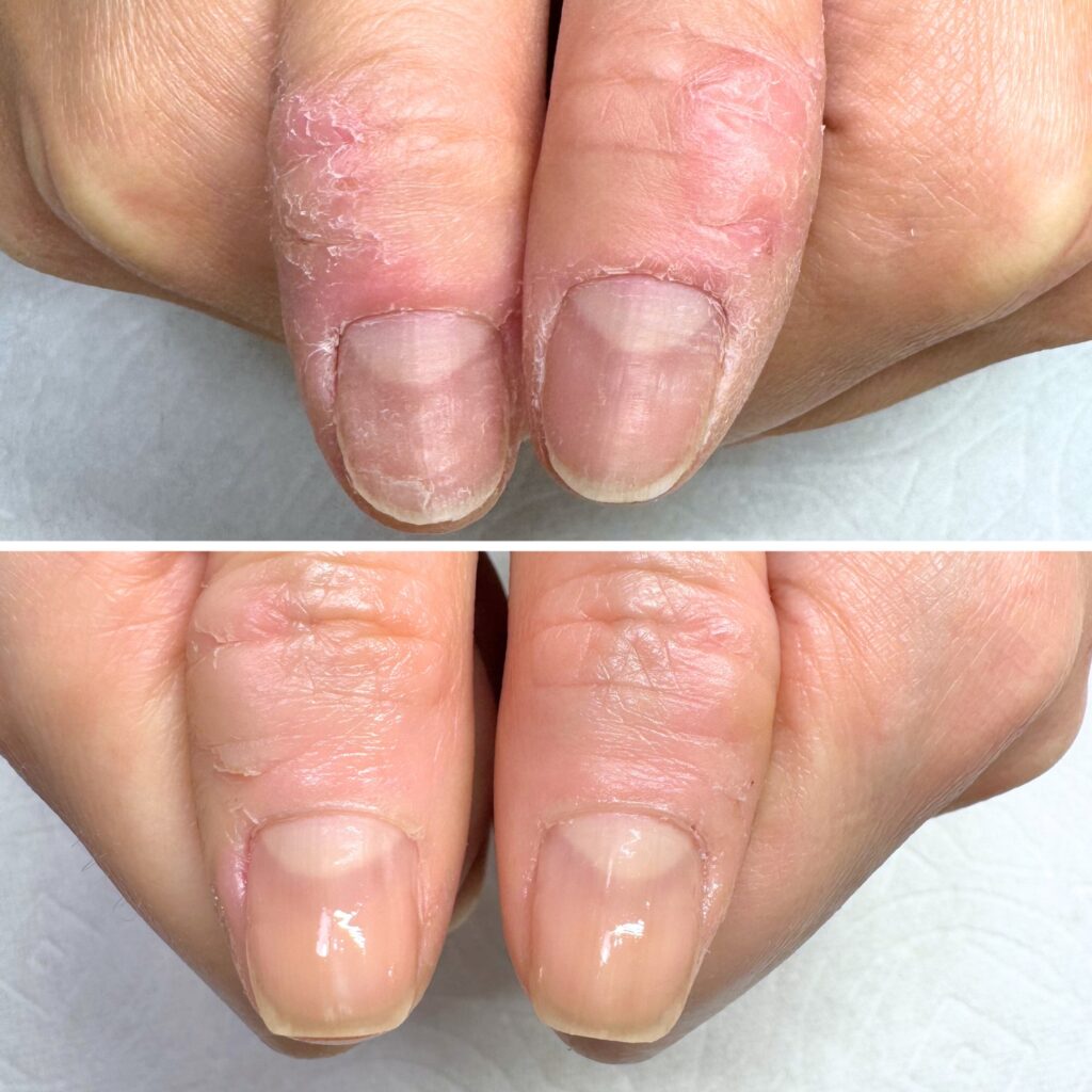 O様 女性/30代/パート
お悩み：皮膚むしり症
初回→8回目(約3ヶ月)の爪の育成写真