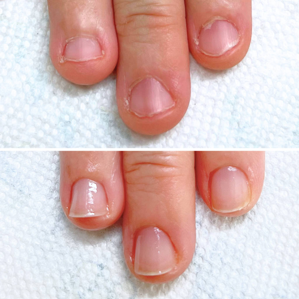 Y様 短い爪 噛み癖 小さい爪症例３