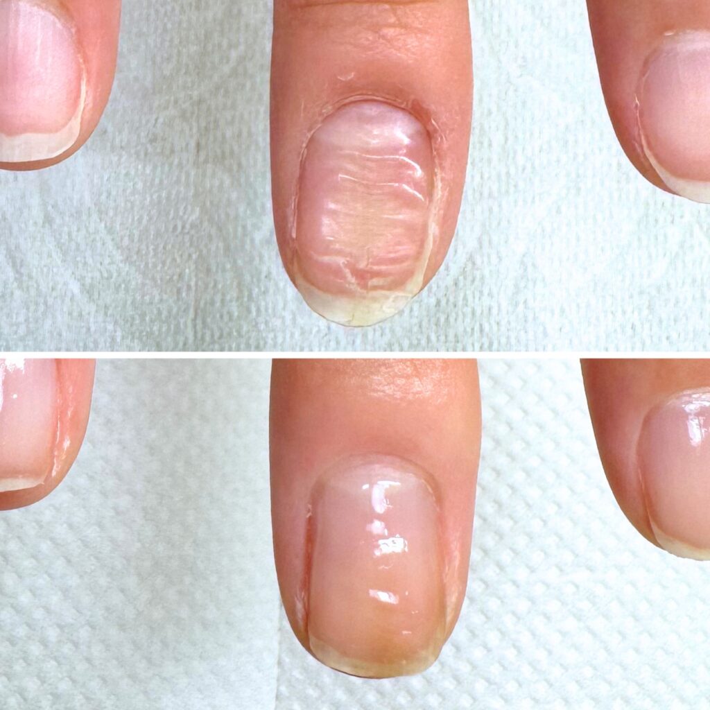 N様 女性/30代/教員
お悩み：爪の変形
初回→8回目(約3ヶ月)の爪の育成写真