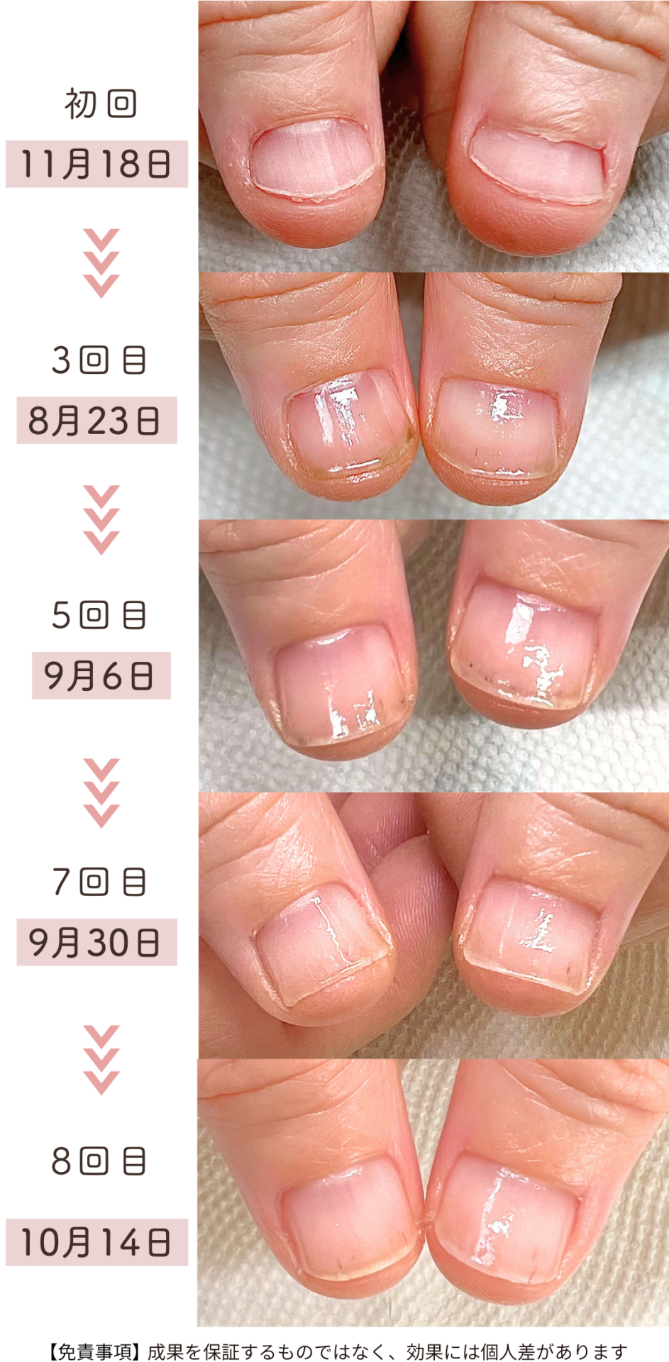 Y様 女性/50代/介護職
お悩み：短い爪 噛み癖 小さい爪3ヶ月育成過程症例