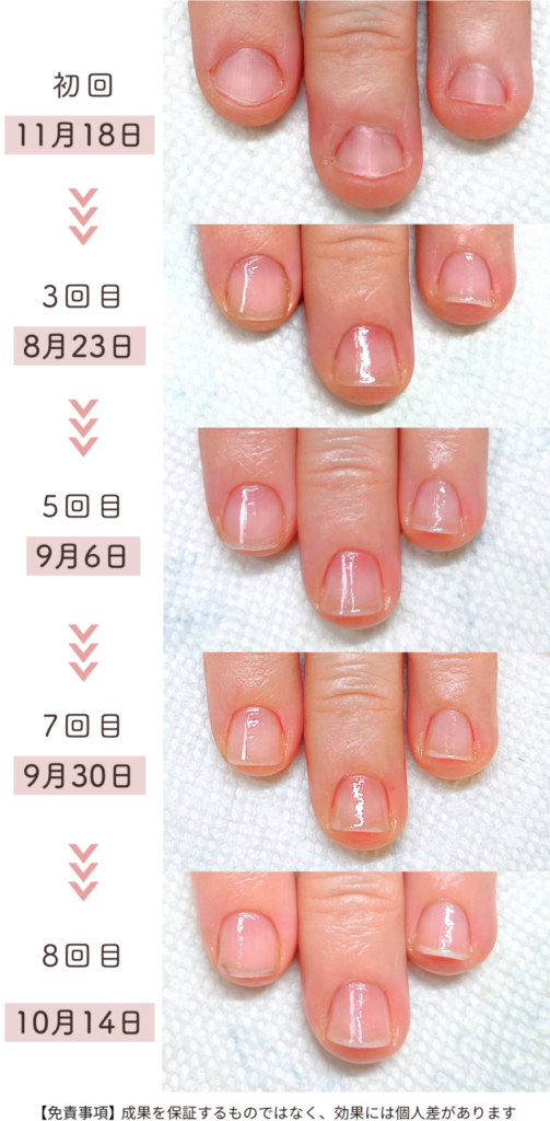 Y様 女性/50代/介護職
お悩み：短い爪 噛み癖 小さい爪3ヶ月育成過程症例